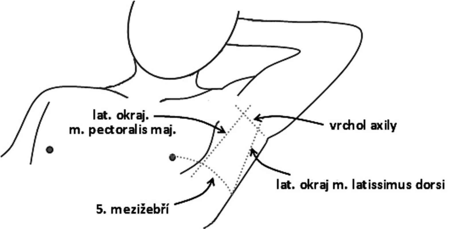 „Safe triangle“ – bezpečný trojúhelník pro umístění hrudního drénu
Fig. 3: The “safe triangle” for the insertion of a chest drain