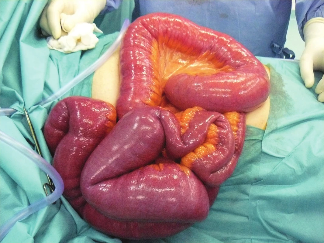 Ileus tenkého střeva na podkladě entero-enterální invaginace
Fig. 6: Ileus of the small intestine due to entero-enteral invagination