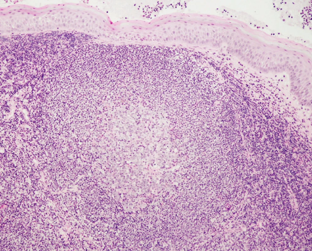 Histologický nález lymfomu z plášťových buněk v resekátu. (Prezentováno z materiálu ÚPAMB UK 2. LF a FNM Motol, Praha, přednosta prof. MUDr. R. Kodet, CSc.)
Fig. 6. Histopathological finding of mantle cell lymphoma. (Investigation at ÚPAMB UK 2. LF et FNM Motol, Praha; with courtesy of prof. R. Kodet, MD, PhD)