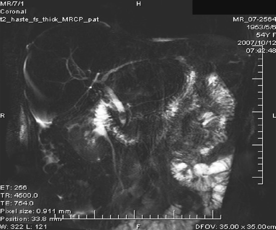 MRCP = choledocholit nad papilou
Fig. 8. MRCP = a choledocholith above the papilla