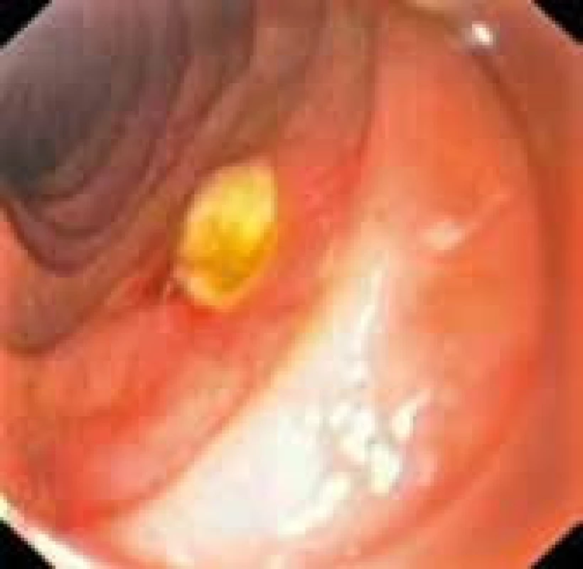 Perforace stěny duodena – stav po endoskopické extrakci drenáže žlučových cest perforující stěnu duodena.
Fig. 3. Perforation of the duodenal wall – status after endoscopic extraction of drainage of the biliary tract perforating duodenal wall.