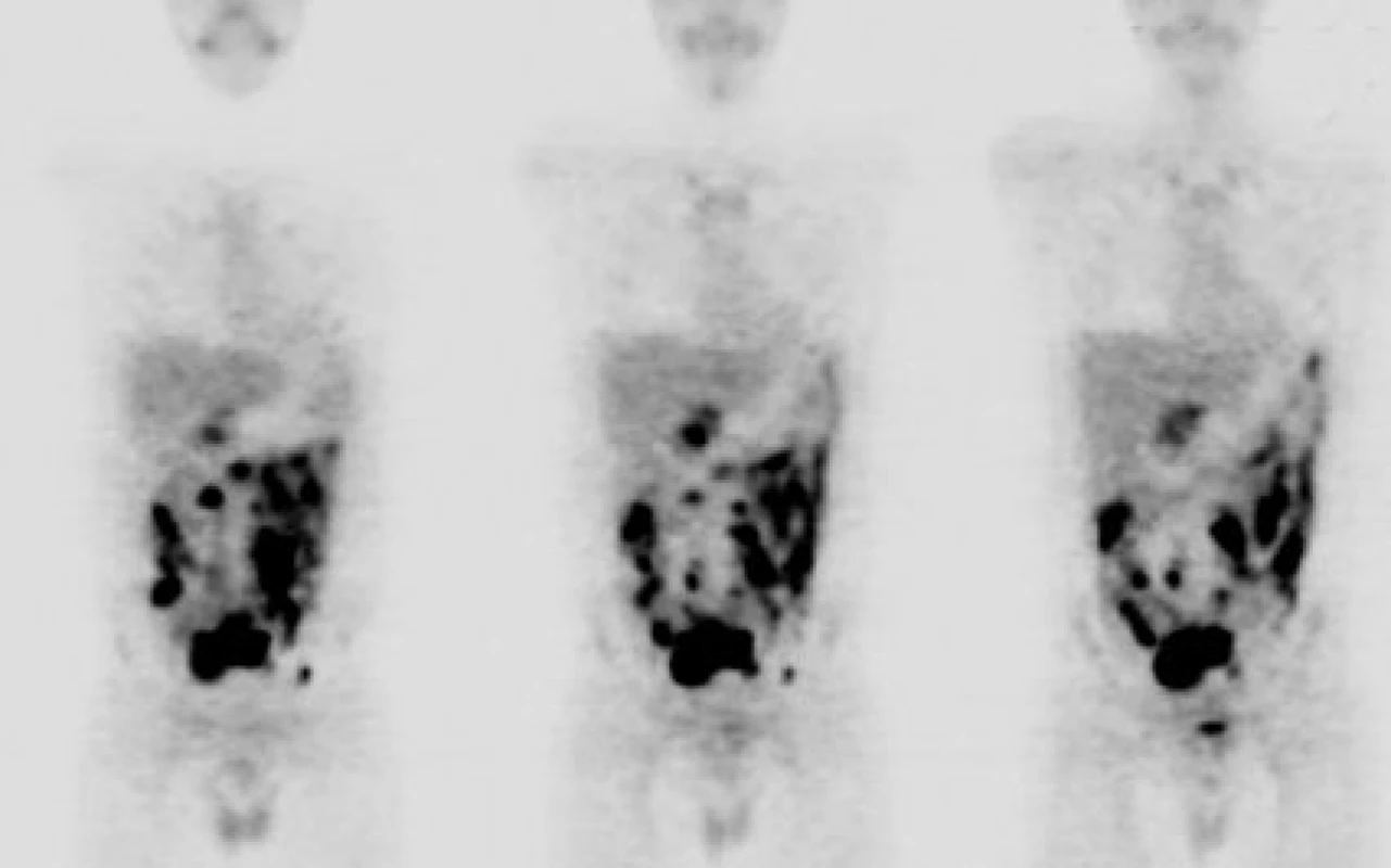 Diagnostika Burkittova lymfomu pomocí celotělové FDGPET (materiál Oddělení nukleární medicíny   a PET, MOÚ, Brno, zpracoval K. Bolčák).
Mnohočetná ložiska s enormně vysokým metabolismem glukózy (SUV 16-22) odpovídající vitální nádorové tkáni v dutině břišní, s maximem ventrálně (pravděpodobně na peritoneu) a ve středním hypogastriu, u pacienta s nově diagnostikovaným Burkittovým lymfomem.
