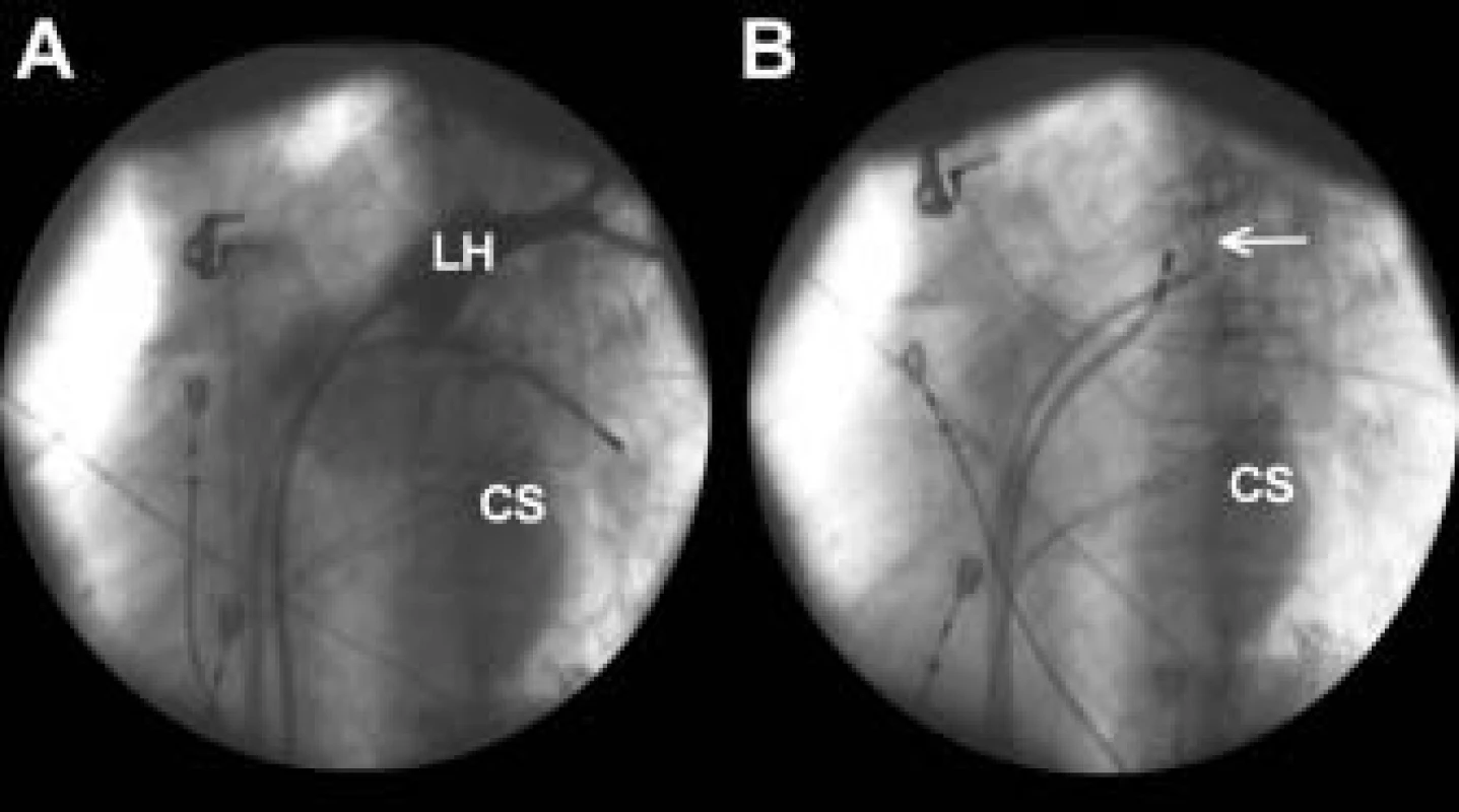 Angiografie plicní žíly a zavedení cirkulárního katétru do plicní žíly.
Na části A je zobrazena levá horní plicní žíla a její ústí do levé síně nástřikem kontrastní látky. Angiografické zobrazení plicní žíly zmrazené na 2. obrazovce skiaskopického přístroje umožňuje přímé hodnocení polohy cirkulárního katétru uvnitř žíly (šipka) (B) a místa aplikací radiofrekvenční energie ablačním katétrem v průběhu výkonu. Angiografické zobrazení plicní žíly poskytuje v průběhu samotného vyšetření neocenitelnou přímou korekci anatomických vztahů plicních žil a levé síně i při použití elektroanatomického mapování.