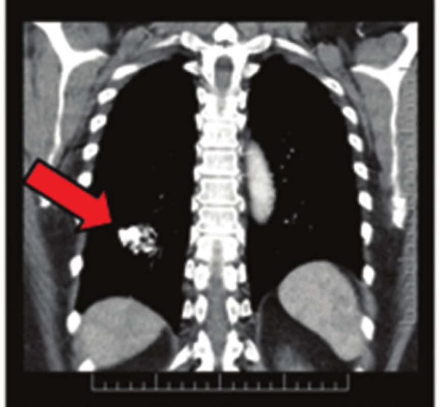 Plicní chondrom na CT snímku
Fig. 4: Pulmonary chondroma on CT scan