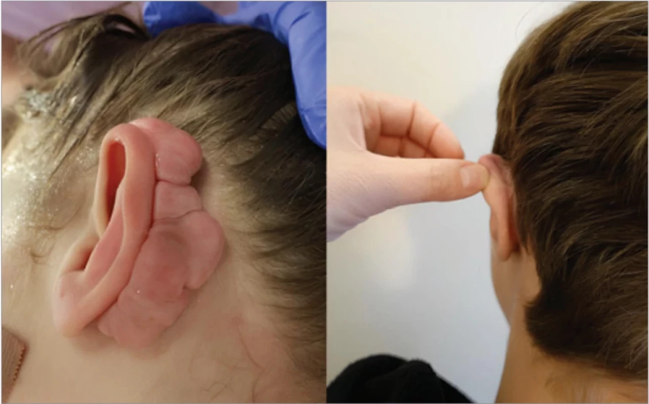 Patient 1 – extensive keloid formation preoperatively (left) and a maturing scar one year post-surgery with strict adherence to the treatment protocol (right).