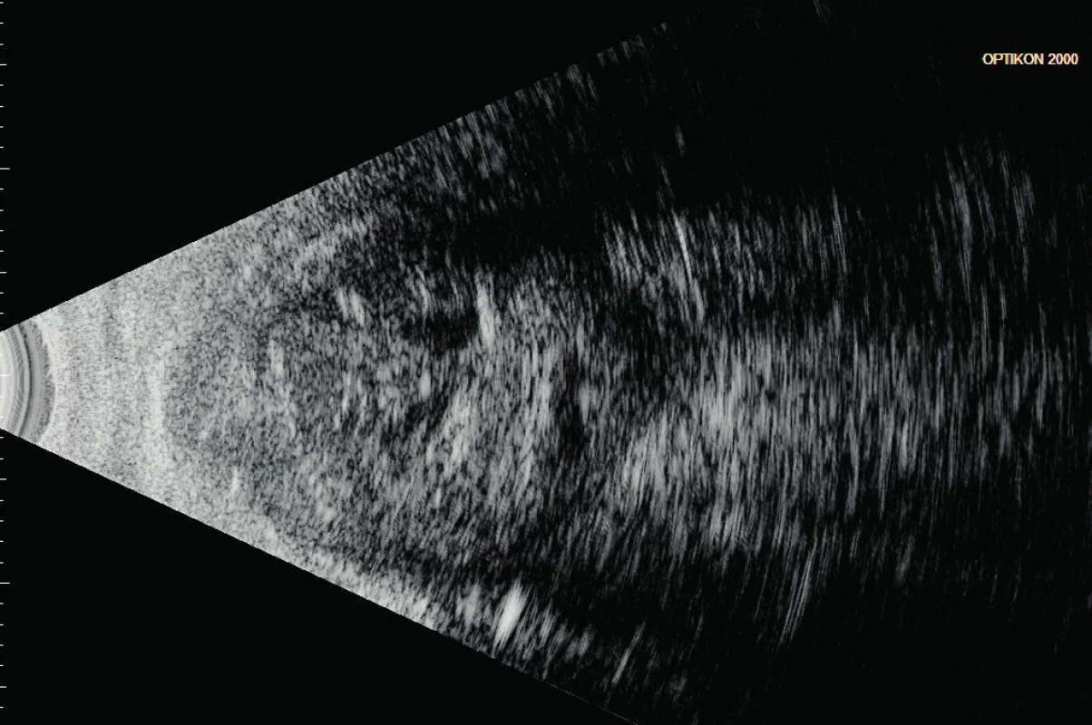 B-scan levého bulbu