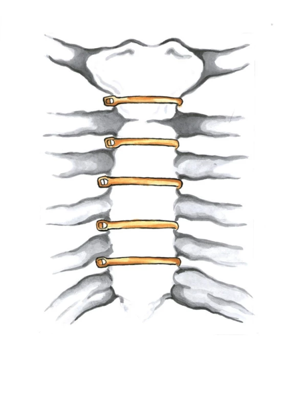 Uzávěr střední sternotomie pomocí sternálních pruhů (Kresba archiv autora)
Fig. 8: Median sternotomy closure with sternal bands
