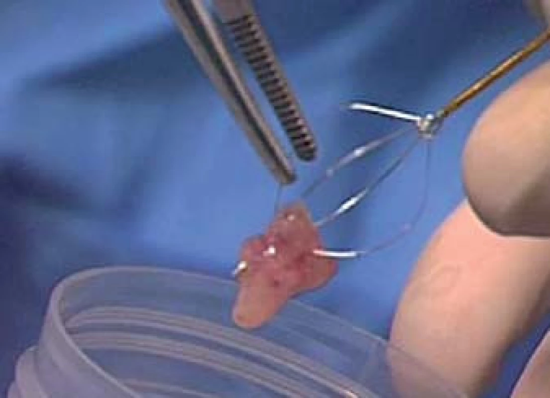 Vzorek je přemístěn přímo do malé nádoby s fyziologickým roztokem (bez fixačního roztoku) a odeslán do cytopatologické laboratoře.