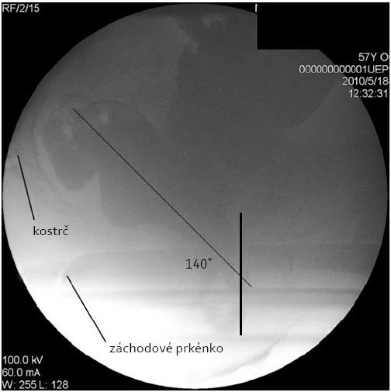 Defekografické vyšetření. Klidové stadium po aplikaci rektálního nálevu. Anorektální úhel je 140°. Patrná velká rektokéla, velikost až 7 cm. 
Fig. 1. Defecography. The resting stage after rectal enema application. The anorectal angle is 140°. A large rectocele up to 7 cm is visible.
Foto: prim. J. Frydrych.