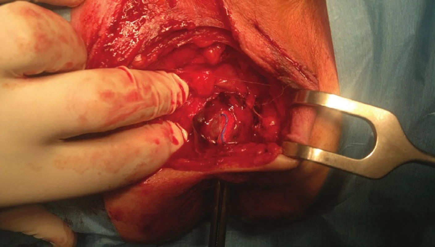 Peroperační nález – defekt rekta
Fig. 2: Operational finding – rectal perforation