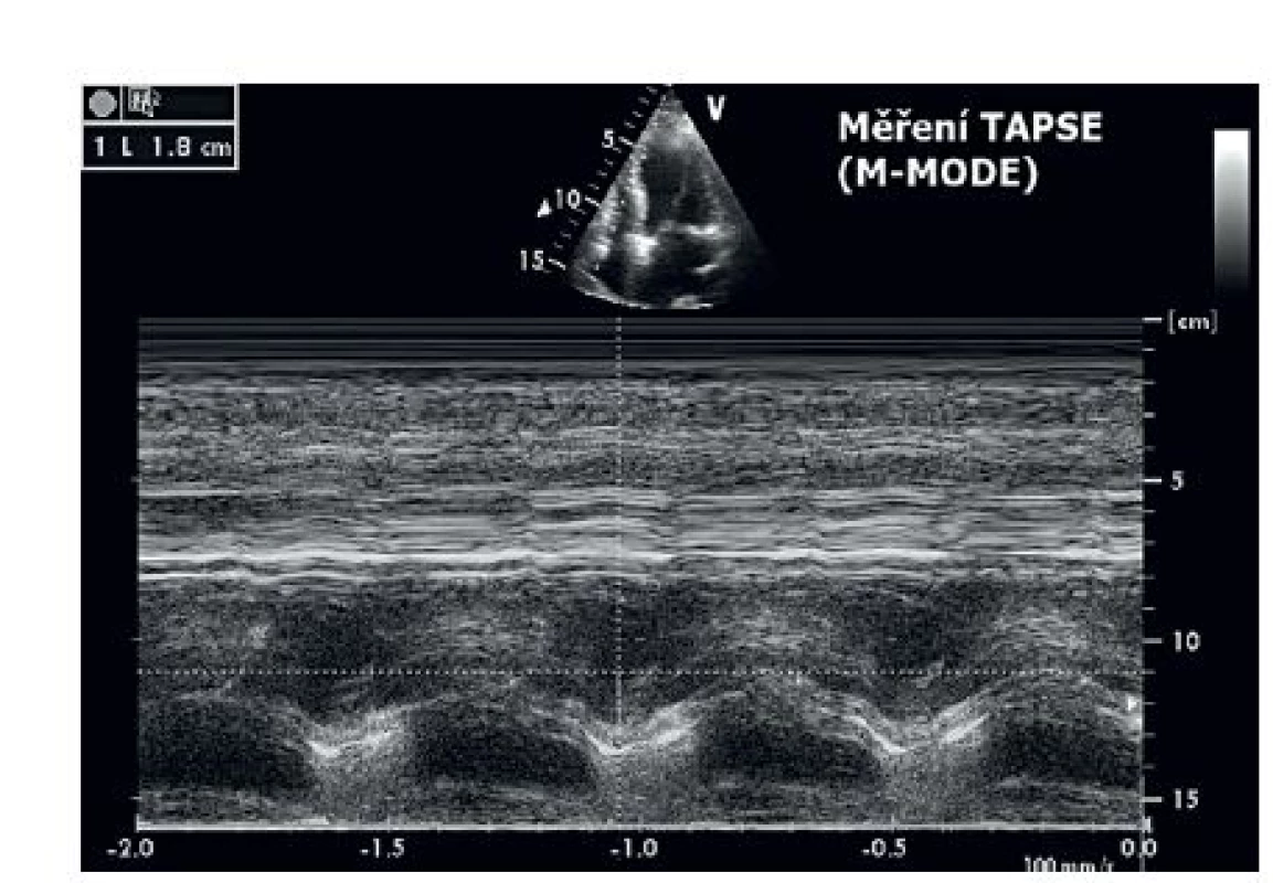 Měření TAPSE při hodnocení longitudinální systolické funkce pravé komory