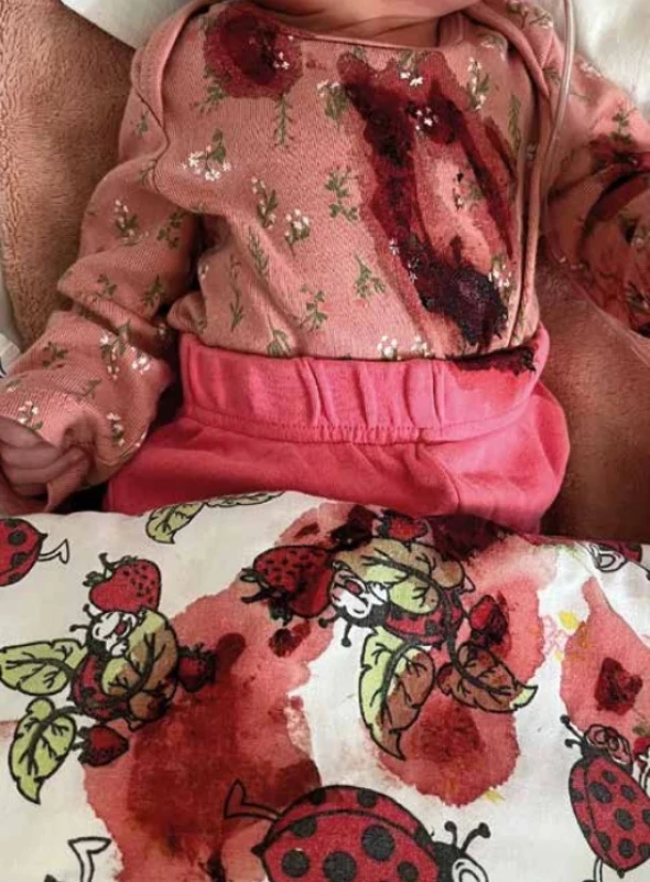 Masívna hemateméza u novorodenca (z archívu Neonatologickej kliniky JLF UK a UNM) 