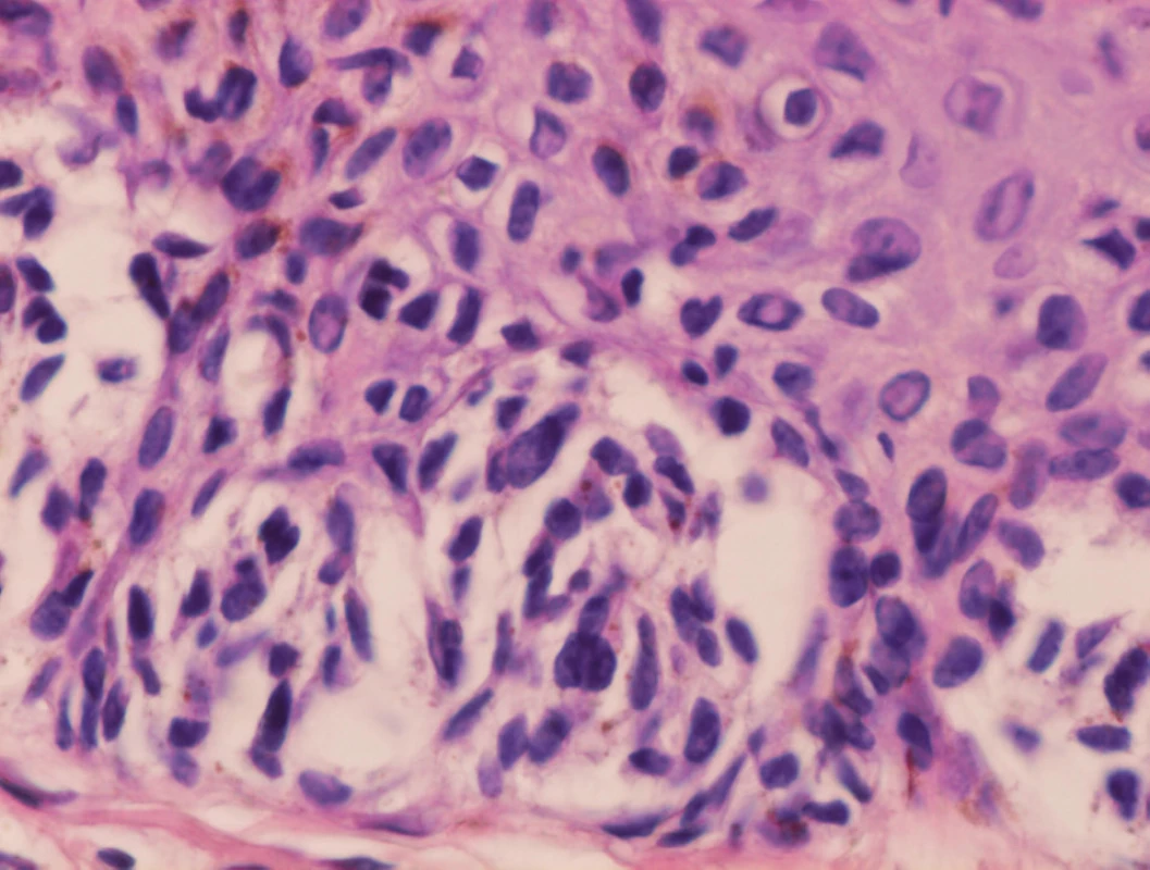 Nepravidelne roztrúsená cytologická atypia v junkčných hniezdach dysplastického névu, jadrá niektorých melanocytov sú zväčšené, hyperchrómne, nepravidelne konturované, iné vyzerajú pomerne pravidelne (HE, 400x).