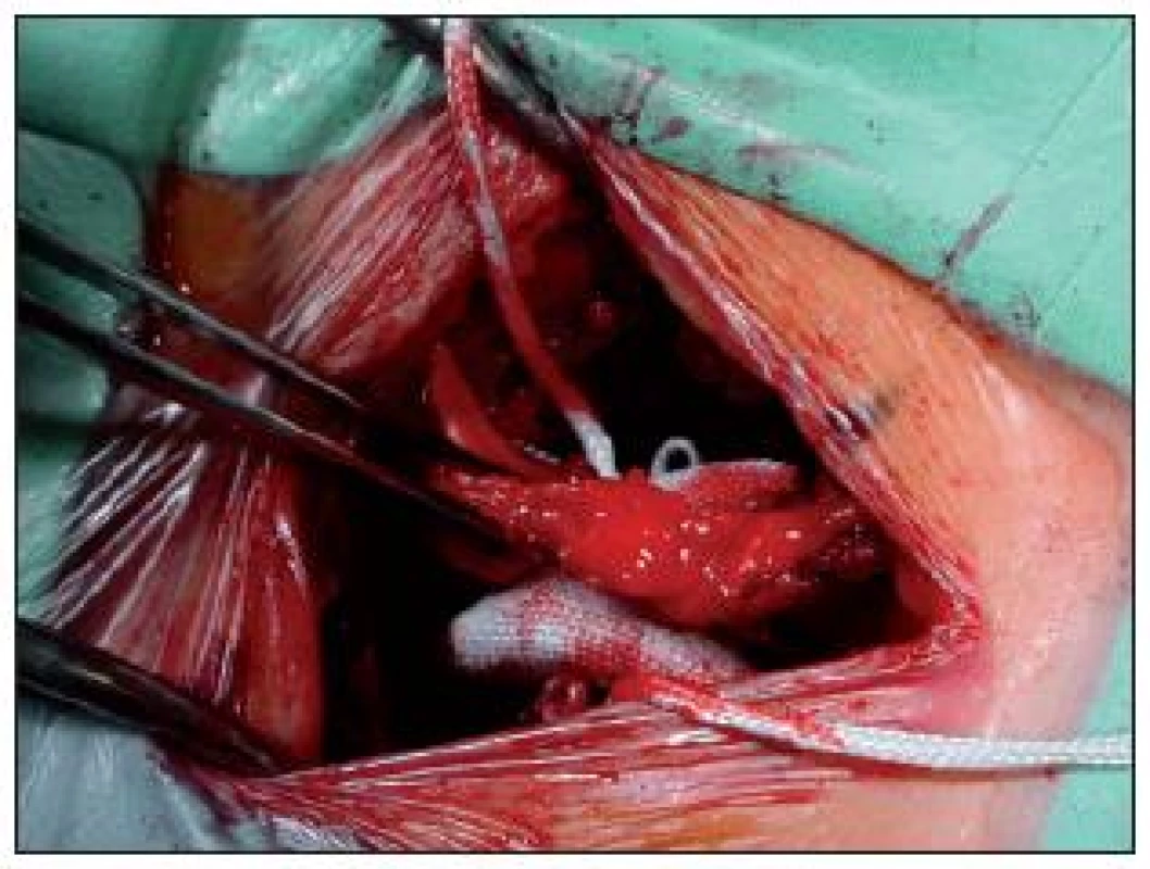 Fotografie operačního pole s rozpěrkou DIAM v interspinózním prostoru L4/5.
Ve střední čáře je pinzeta držící pevný supraspinózní vaz. Po stranách implantátu jsou ouška a dosud neimplantované tkanice.