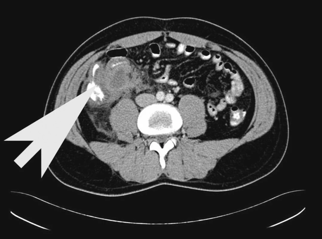 Zánětlivý infiltrát paracékálně po apendektomii
Fig. 3. Inflammatory paracecal infiltration following appendectomy