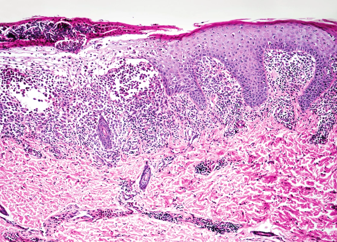 Kožní biopsie při barvení hematoxylin-eosinem, 100x zvětšeno, hyperkeratóza s hnisavou krustou a infiltrací nádorovými elementy.
Fig. 4. The skin biopsy, hematoxylin eosin staining, 100x enlargement, hyperkeratosis with purulent crust nad infiltration of tumorous elements.