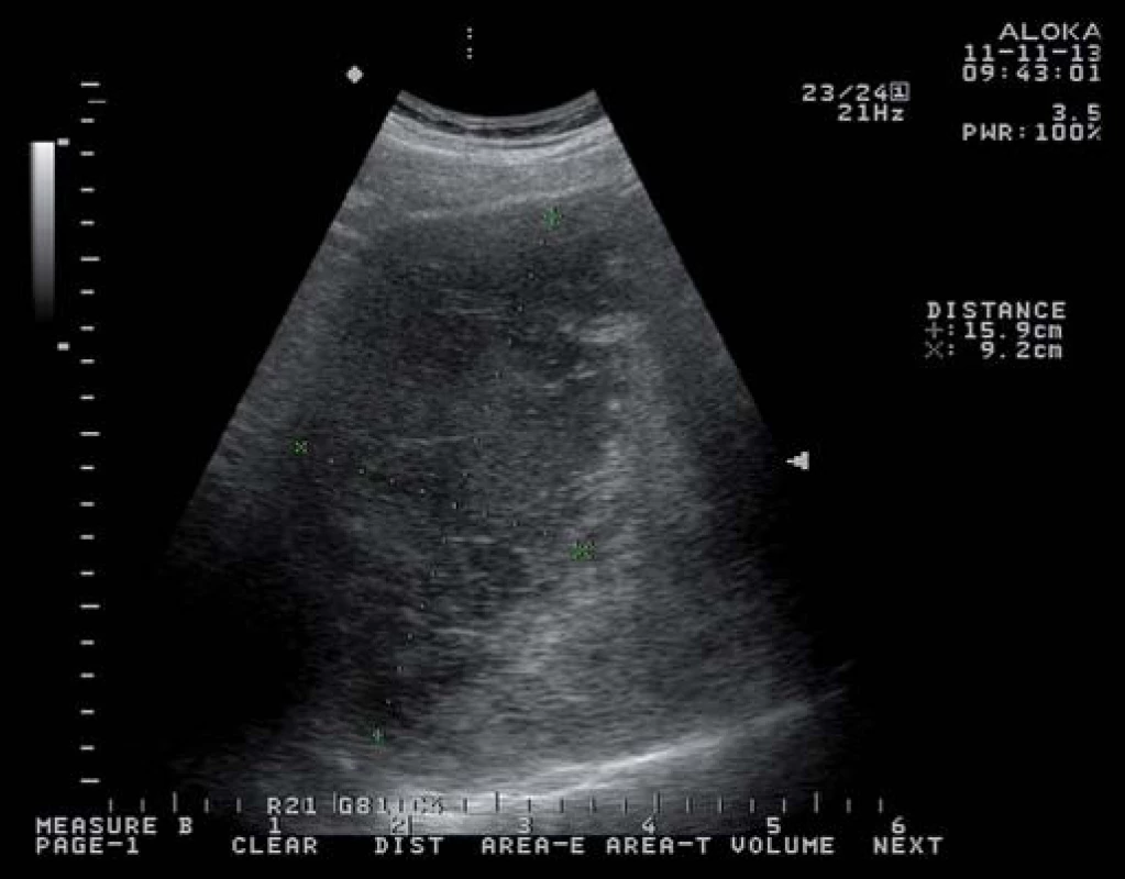 Hypoechogenní ložisko pravého jaterního laloku, suspektní hematom.
Fig. 1. Hypoechoic lesion in the right lobe of liver, suspected haematoma.