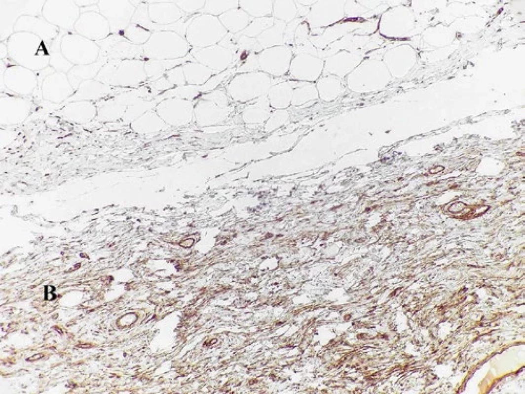 Imunohistochemický dôkaz expresie CD34. Vretenobunkový lipóm (B) je pozitívny, zatiaľ čo klasický lipóm (A) je negatívny. (objektív 20×)