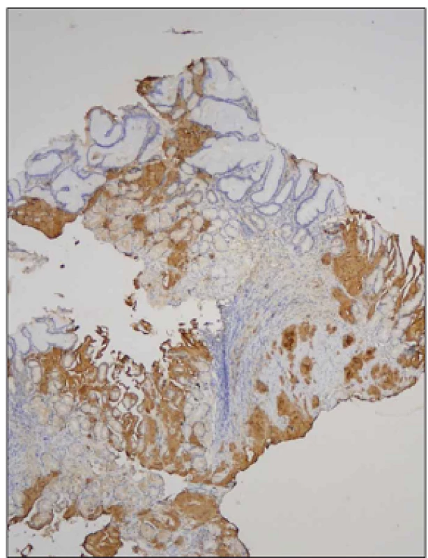Biopsie žaludku, nepřímá imunohistochemie, protilátka proti transtyretinu, zvětšení 40x.
