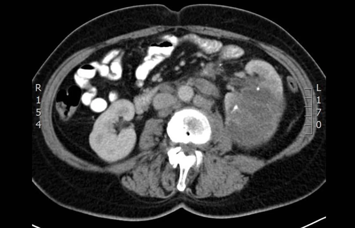 CT vyšetření: cystický útvar ledviny se septy a kalcifikacemi ve stěně klasifikovaný jako cysta Bosniak 3 – kaudální část
Fig. 2. CT: axial section at the level of cystic formation of a kidney with septum and calcifications in cysts wall classified as Bosniak III – caudal part
