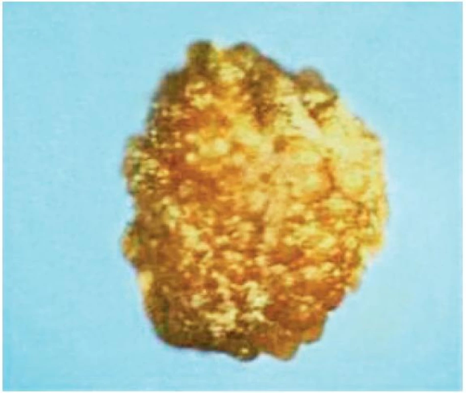Exstirpovaný pseudotumor