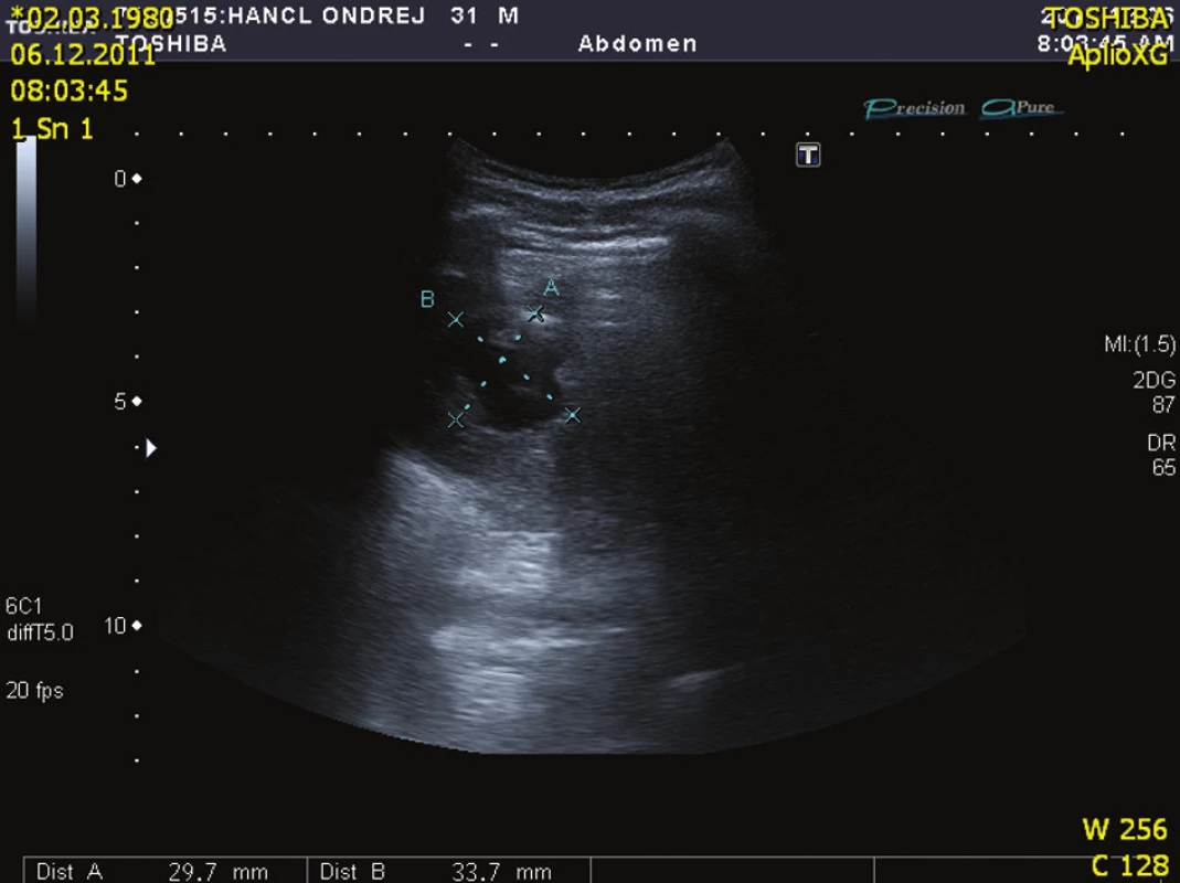 USG kontrola po roce (kazuistika 2)
Fig. 10: Control ultrasound after one year (case 2)