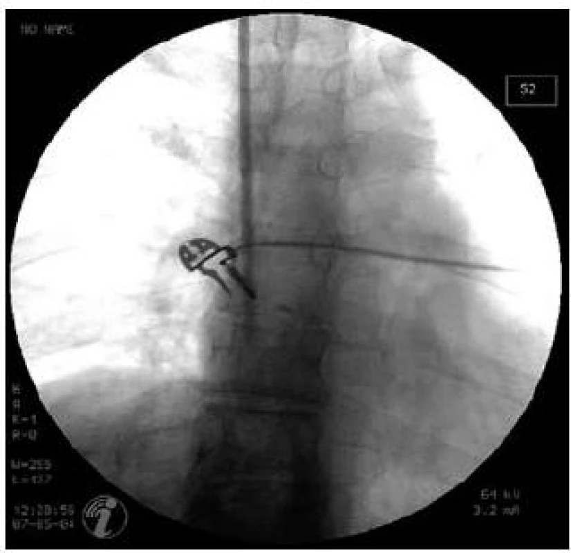 Zavaděč v oblasti horní duté žíly. Zahájení katetrizace jaterních žil punkcí jugulární žíly.
Fig. 1. Introducer in the superior vena cava. Initial phase of hepatic vein catheterization – jugular vein puncture.