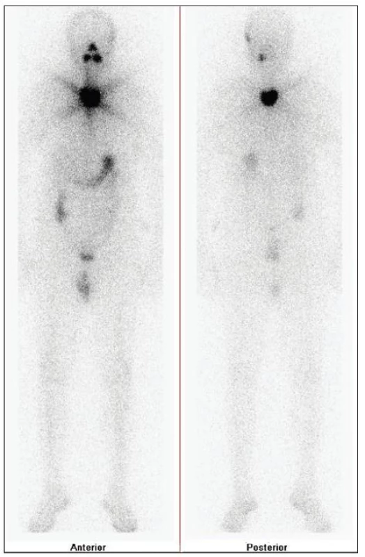 Celotělová scintigrafie v přední a zadní projekci po terapii <b>7,4 GBq <sup>131</sup>I</b> s výrazně kontrastní depozicí <b>radiojódu</b> ve střední rovině v oblasti jugula, další malé ložisko je patrné vysoko na krku vlevo.