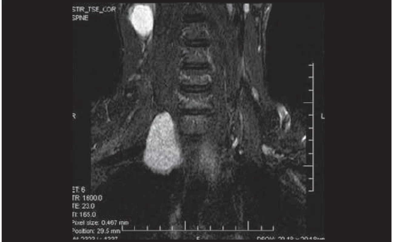 MR – neurinom – rezistence lateroventrálně od páteře; s laskavým svolením Radiodiagnostického oddělení, Krajské nemocnice Liberec, a.s.
Fig. 1. MRI – neurinoma – resistance latero anterior to the spine; courtesy of the Radiodiag nostic Department, Liberec Regional Hospital, Inc.