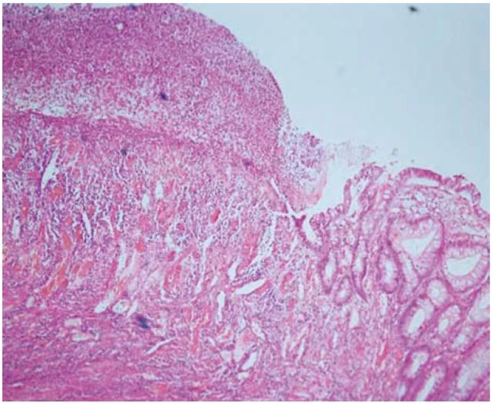 Histologický obraz ulcerácie, colon ascendens, hematoxylín eozín.
Fig. 3. Histologic specimen of ulceration in colon ascendens, haematoxylin eosin.
