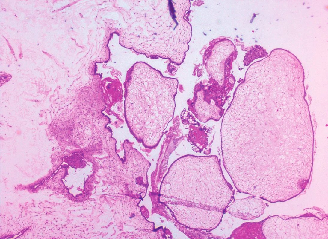 Edematózní choriové klky se zastižením jak tlakově atrofického, tak jinde hyperplastického trofoblastu. Hyperplastický trofoblast po obvodu klků a bezcévná stěna klků jsou typickými pro kompletní hydatidózní molu [17]. V edematózním stromatu některých klků jsou prázdné prostory, tzv. cisterny [23]. Zvětšeno 25x. MUDr. Dvořáková Klára, patologie Jihlava.