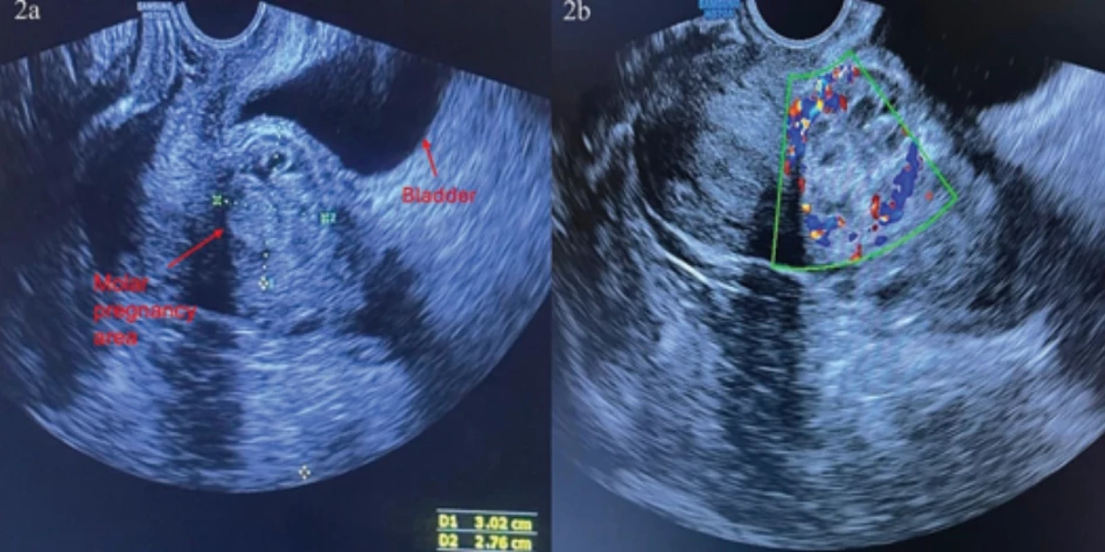 a) After revision curettage, a 30 × 27 mm heterogeneous molar pregnancy lesion protruding toward the serosa was detected at the site of the previous cesarean section scar. The arrow indicates the uterine bulge toward the bladder, considered a pathognomonic feature of cesarean scar ectopic pregnancies. 2b) Colour Doppler ultrasound demonstrating vascularity within the molar pregnancy lesion. Obr. 2a) Po revizní kyretáži byla v místě jizvy po předchozím císařském řezu detekována heterogenní těhotenská léze moláru o rozměrech 30 × 27 mm, vyčnívající směrem k seróze. Šipka označuje děložní vyboulení směrem k močovému měchýři, které je považováno za patognomický rys mimoděložních těhotenství po císařském řezu. 2b) Barevný Dopplerovský ultrazvuk prokazující vaskularitu uvnitř těhotenské léze moláru.