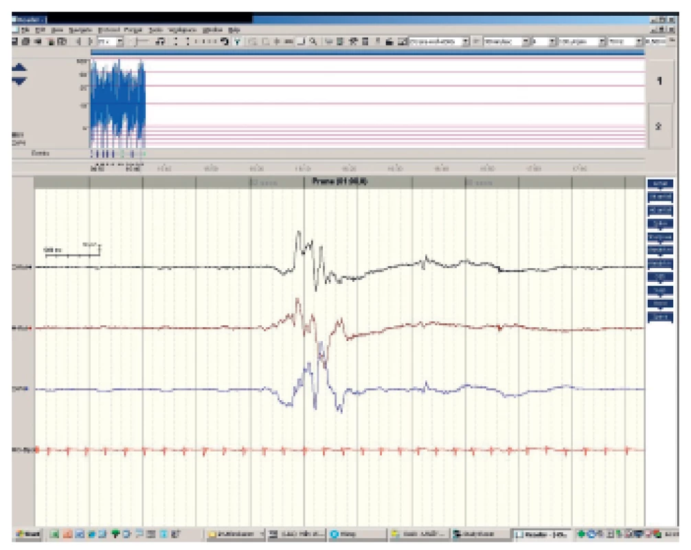 aEEG obraz diskontinuity bez epileptogenní aktivity.
Fig. 1. Burst supression – without spike activity.