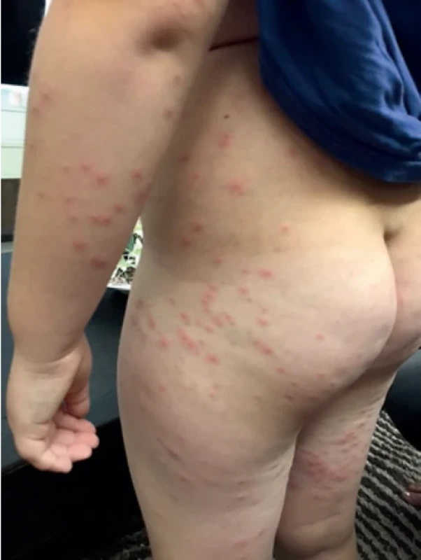 Hot tub folliculitis
