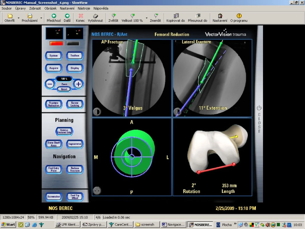 Osteosyntéza bérce s využitím upraveného programu pro osteosyntézu femuru
