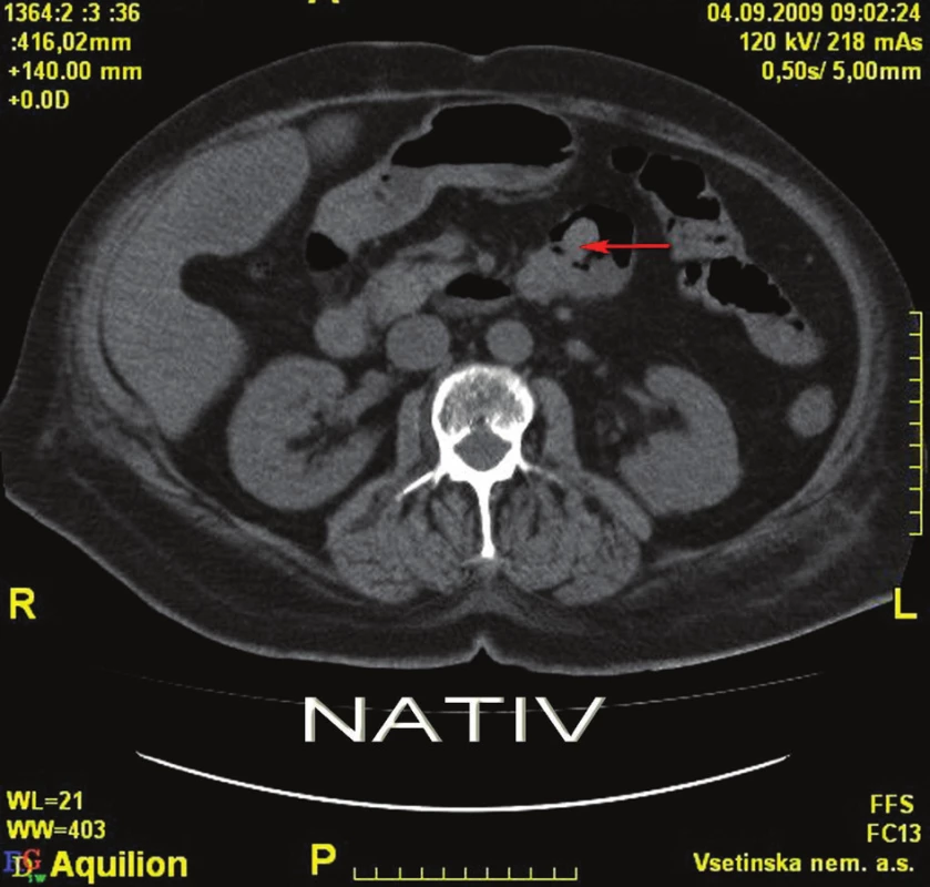 CT nativ – tumorózní léze duodena
Fig. 2: Plain CT – tumorous lesions of the duodenum
