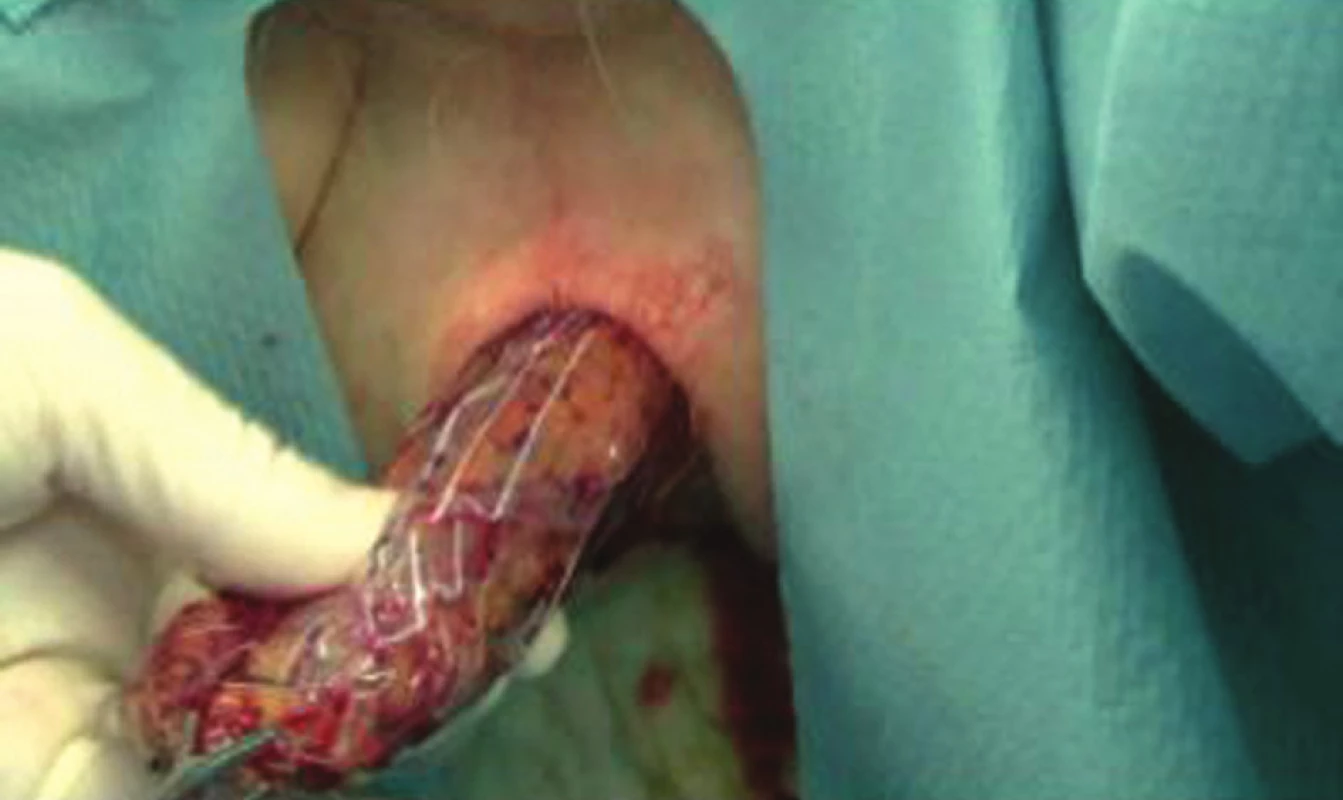 Transanalní odstranění preparátu
Obr. 1: Transanal specimen extraction