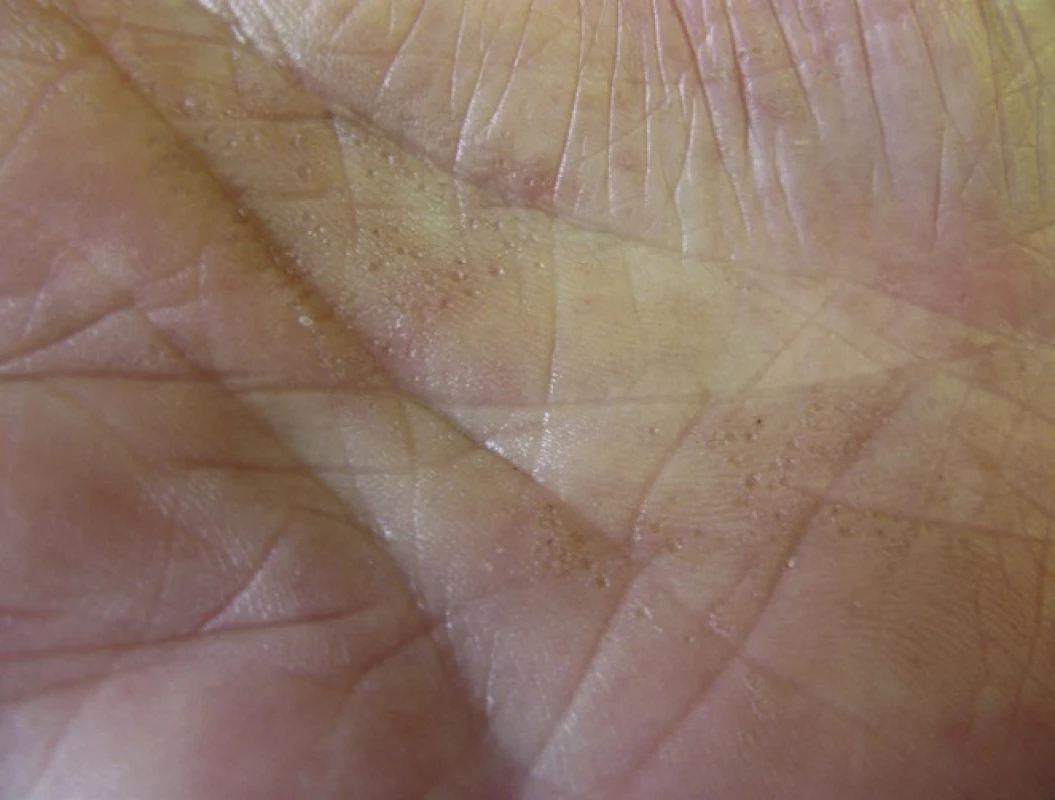 Porokeratosis punctata palmaris et plantaris