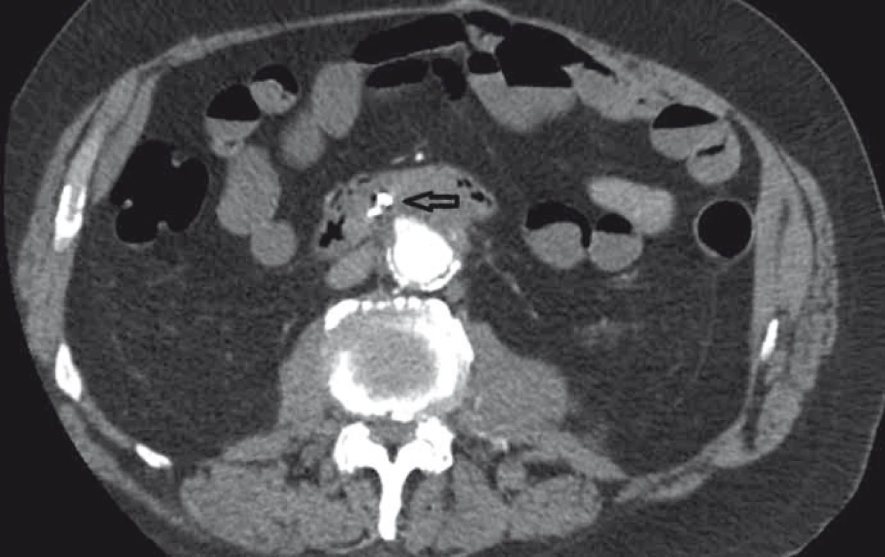 CT angiografie, transverzální zobrazení, arteriální fáze (šipka ukazuje píštěl).
Fig. 3. CT angiography, transversal view, arterial phase (the arrow points to the fistula).