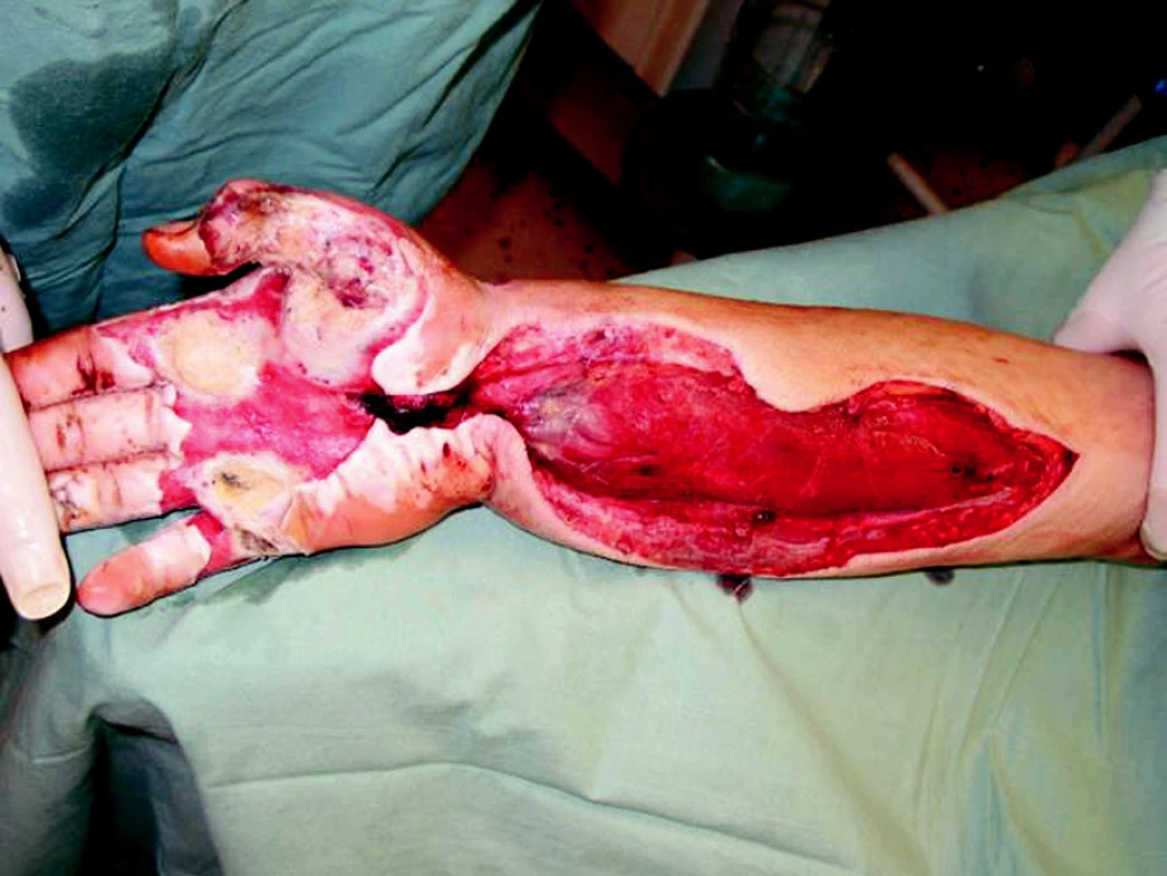 Right upper extremity second day after the injury