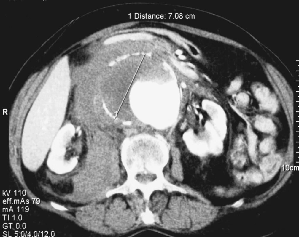 5. Rupturované velké juxtarenální AAA u 82leté nemocné
Fig. 5. Ruptured large juxtarenal AAA in a 82-year old female patient