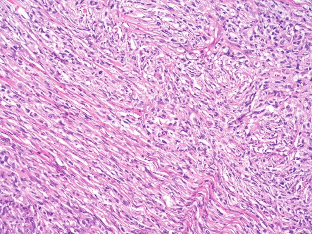 Při větším zvětšení je patrný fascikulární a vágně vírovitý charakter růstu nádorových buněk. Hematoxylin-eozin, původní zvětšení 200krát.