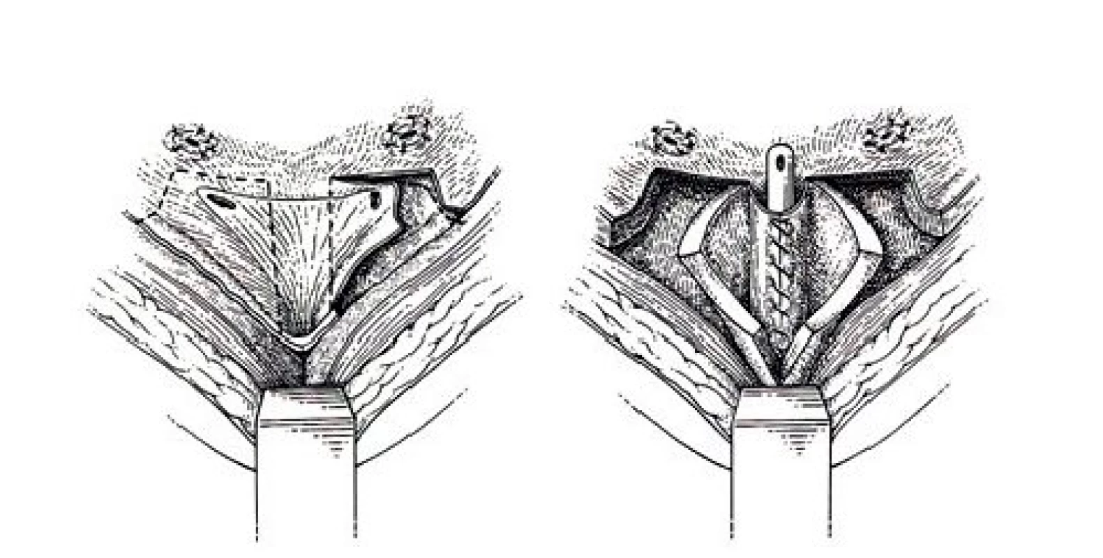 Schéma plastiky dle Younga–Deese–Leadbettera zvyšující výtokovou rezistenci.
Fig. 5. Schematic Young–Dees–Leadbetter plasty enhancing the outflow resistence.