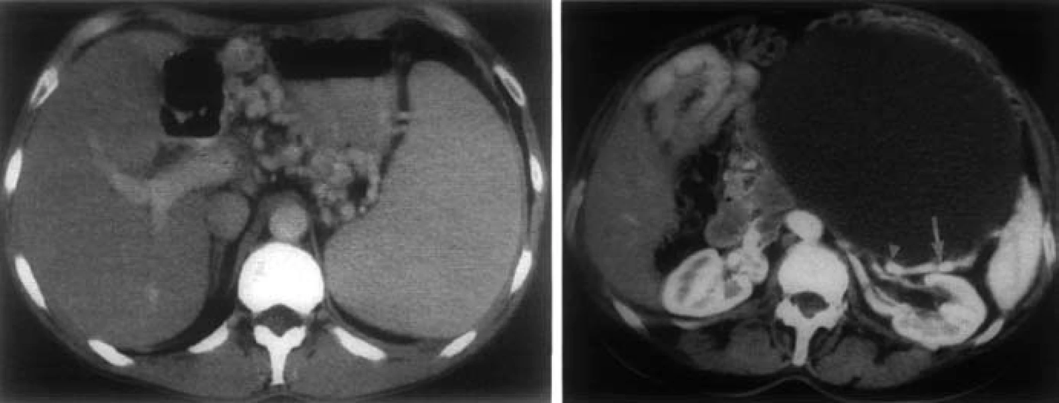 CT nález pri SPH. A – splenomegália, masívne gastrické varixy, B – pankreatický cystadenom. Lienálna véna (šípka) je uložená tesne za zadnou stenou TU a javí sa prerušená (trojuholník) [8].
Fig. 7. CT findings in SPH. A – splenomegaly, massive gastric varices, B – pancreatic cystadenoma. Splenic vein (arrow) is placed just behind the posterior wall of the tumor and appears broken (triangle) [8].