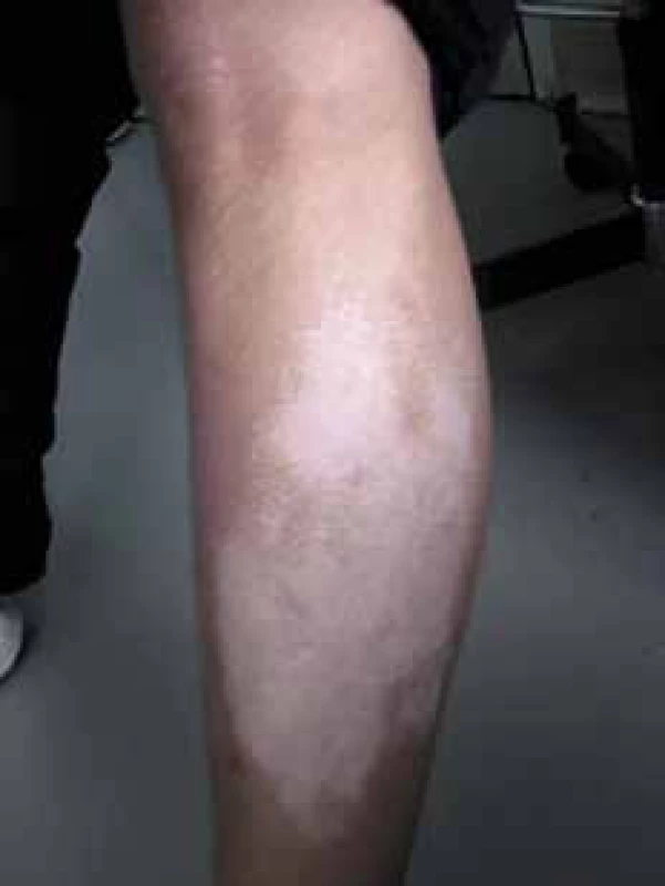 Vitiligo