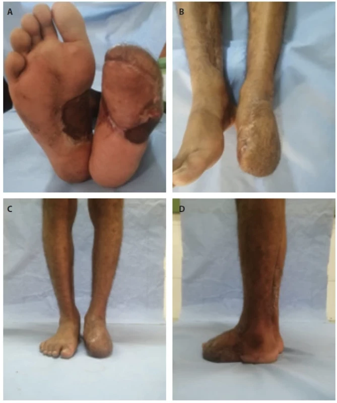 Four years follow up A) medial plantar, B) posterior tibial fl aps, C, D) the patient is weight-bearing well.