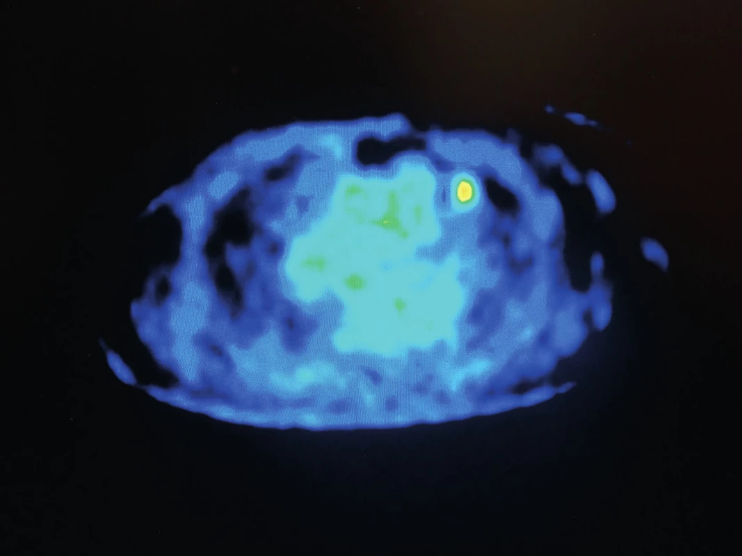 PET pozitivita ložiska vlevo
Fig. 3: PET positivity of the infiltration in left lung parenchyma