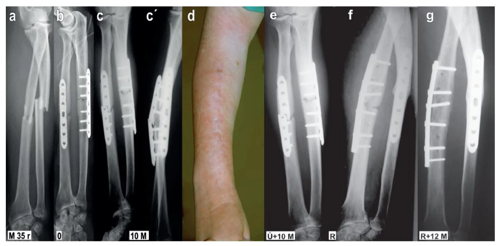 Vliv rigidity osteosyntézy na hojení zlomeniny: a – muž, 35 roků, s příčnou zlomeninou obou předloketních kostí, tento typ poranění vzniká přímým násilím a je spojen s rozsáhlejším poraněním měkkých tkání; b – osteosyntéza LCP (zamykacími) dlahami 3.5 mm v konfiguraci 3+3, dlaha na radius byla přiložena na jeho dorzální plochu; c+c´ – pakloub radia se zlomením dlahy za 10 měsíců po operaci, rovněž ulna není dosud zhojena; d – kosmeticky nevyhovující jizva po posterolaterálním přístupu na mechanicky exponovaném místě; e – pakloub radia a zlomená dlaha za 10 měsíců po operaci; f – eoperace pakloubu radia, fixace laterálně aplikovanou modelovanou 8otvorovou DCP dlahou 3.5 mm v konfiguraci 3+3, g – dokonalé zhojení za rok po reoperaci.
Fig. 8: Effect of internal fixation rigidity on fracture healing: a – a man, 35 y, with a transverse fracture of both forearm bones, this type is caused by direct violence and is associated with a more extensive soft tissue lesion; b – internal fixation by 3.5mm LCP (locking) plates in 3+3 configuration, radius plate was placed on its posterior surface; c+c´ – non-union of radius with breaking of the plate 10 months postoperatively, ulna has not healed yet, either; d – cosmetically unsatisfactory scar after posterolateral approach on mechanically exposed site; e – non-union of radius and breaking of the plate 10 months postoperatively; f – reoperation of non-union of radius, fixation with a laterally placed contoured 8-hole 3.5mm DCP plate in 3+3 configuration, g – complete union one year postoperatively.