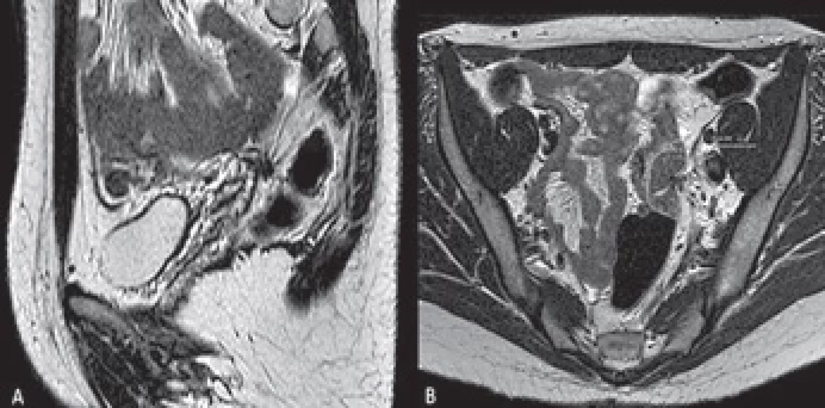 Sagittal T2-weighted MRI demonstrating a spiculated, needle-like localization of endometriosis on the uterosacral ligament and on the peritoneal refl ection plane (A) (red arrow). Axial T2-weighted MRI detecting a localization of deep pelvic endometriosis infi ltrating the full thickness of the distal sigmoid loops (blue line and blue contour) (B).