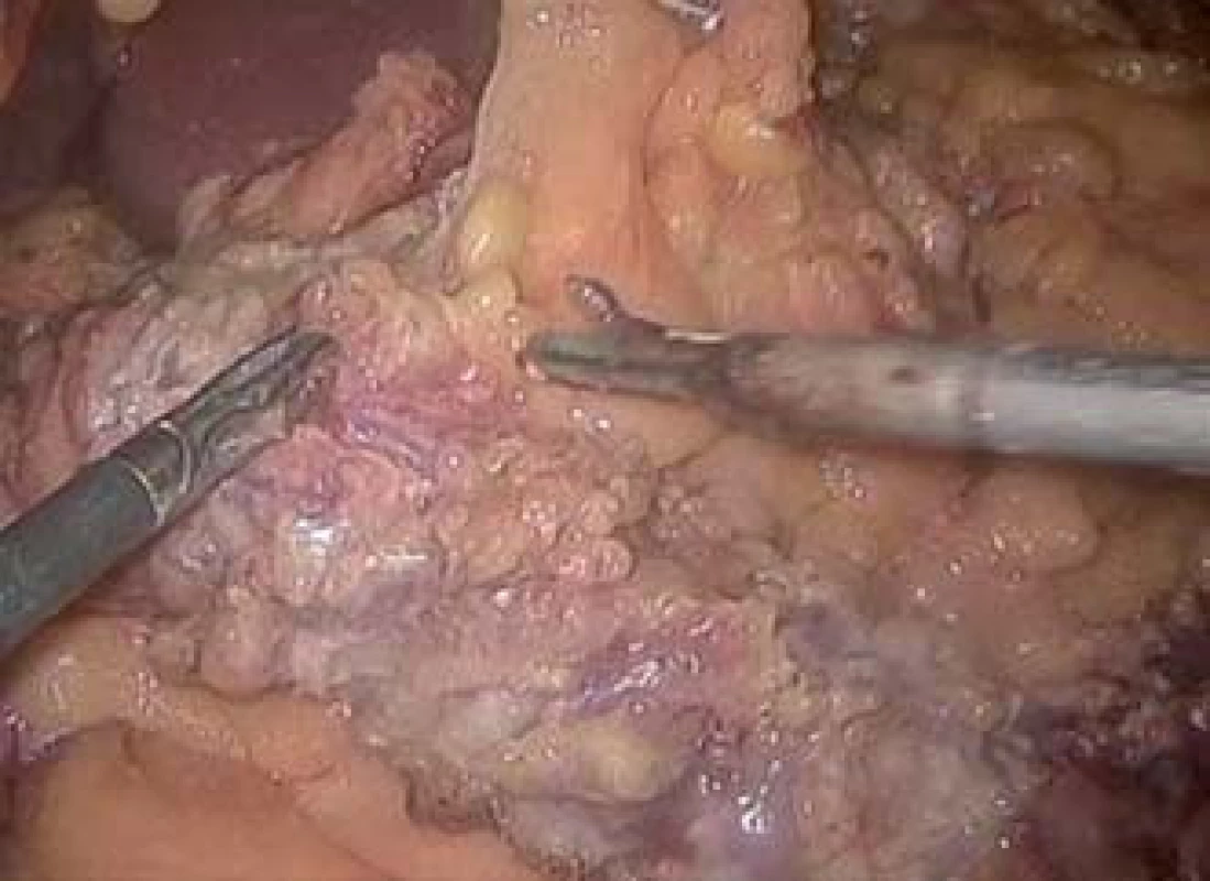Laparoskopický pohled při subtotální kolektomii u IBD.
Fig. 3. Laparoscopic view during the subtotal colectomy in an IBD patient